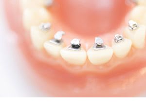 なぜ歯列矯正後の定期検診が必要なのか？