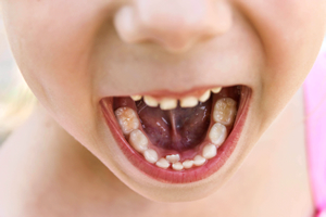 子供の前歯の歯並びは一時的に悪くなる