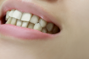 歯並びが悪い人は虫歯を再発させやすい