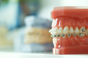 歯列矯正で噛み合わせが良くなり不定愁訴も改善