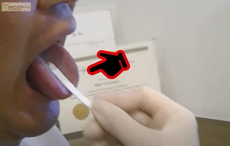 舌からミュータンス連鎖球菌を採取