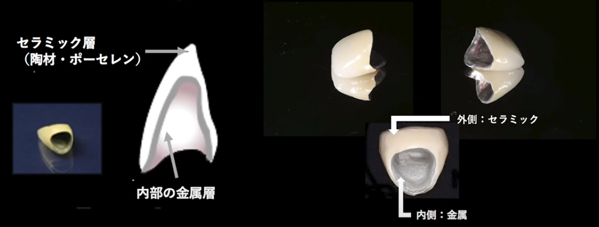 審美歯科に使われる素材について理事長と歯科技工士さんが徹底解説！